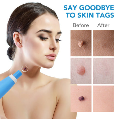 Skin Tag Removal Kit